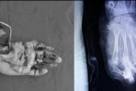 Nguy cơ mất toàn bộ bàn tay trái vì pháo nổ