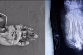 Nguy cơ mất toàn bộ bàn tay trái vì pháo nổ