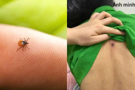 Sốt cao, rét run, người đàn ông 46 tuổi nguy kịch từ vết mò đốt