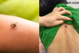 Sốt cao, rét run, người đàn ông 46 tuổi nguy kịch từ vết mò đốt