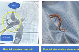 Tán sỏi đường mật, phát hiện giun trong ống mật