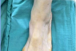 Người phụ nữ nhiều năm chịu đựng những cơn đau buốt bàn chân vì vẹo ngón cái