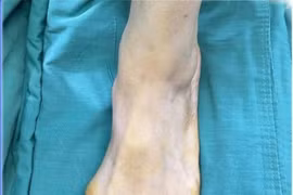 Người phụ nữ nhiều năm chịu đựng những cơn đau buốt bàn chân vì vẹo ngón cái