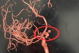 Điều trị thành công ca vỡ phình động mạch thông trước cho người nước ngoài