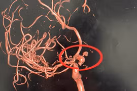 Điều trị thành công ca vỡ phình động mạch thông trước cho người nước ngoài