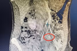 Phát hiện xương cá 5 cm đâm thủng ruột non sau 5 ngày đau bụng