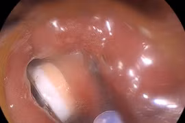 Viên thuốc còn nguyên vỏ kẹt tại thực quản người đàn ông 49 tuổi