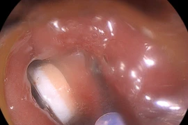 Viên thuốc còn nguyên vỏ kẹt tại thực quản người đàn ông 49 tuổi