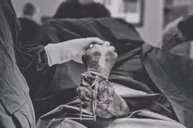 Vi phẫu nối lại cẳng tay đứt lìa cho nam bệnh nhân