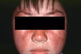 Trẻ 13 tuổi suy hô hấp, tổn thương phủ tạng do lupus ban đỏ