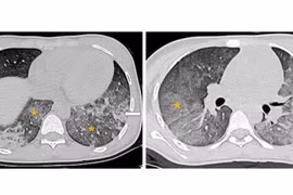 Nghẹt thở hành trình cứu trẻ 14 tuổi biến chứng lupus ban đỏ