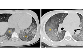 Nghẹt thở hành trình cứu trẻ 14 tuổi biến chứng lupus ban đỏ