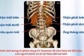 Ca tán sỏi phức tạp cho người đàn ông có dị tật thận đôi cực hiếm gặp