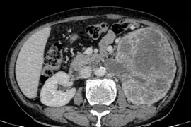 Tiểu máu, bụng chướng nhẹ phát hiện u thận khổng lồ xâm lấn đài bể thận