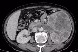 Tiểu máu, bụng chướng nhẹ phát hiện u thận khổng lồ xâm lấn đài bể thận