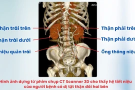Ca tán sỏi phức tạp cho người đàn ông có dị tật thận đôi cực hiếm gặp