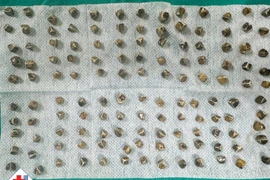 Viêm túi mật cấp đe dọa tính mạng vì 130 viên sỏi trong túi mật 