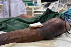 Người đàn ông sốc nhiễm khuẩn, suy hô hấp nặng vì bị gai đâm