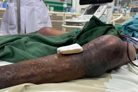 Người đàn ông sốc nhiễm khuẩn, suy hô hấp nặng vì bị gai đâm