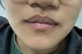 Phát hiện kịp thời u men xương hàm cho thiếu nữ 17 tuổi, tránh biến dạng mặt