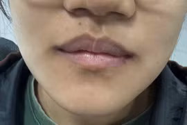 Phát hiện kịp thời u men xương hàm cho thiếu nữ 17 tuổi, tránh biến dạng mặt