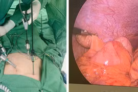 Viêm ruột thừa dưới gan thường gây nhầm lẫn với các bệnh lý gan mật, dạ dày