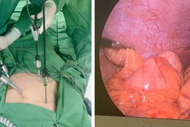 Viêm ruột thừa dưới gan thường gây nhầm lẫn với các bệnh lý gan mật, dạ dày