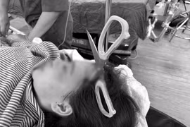 Cô gái 25 tuổi bị kéo nhọn găm xuyên sọ sâu 5 cm