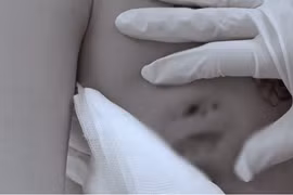 Cấp cứu lấy mô hoại tử cho cô gái áp xe nặng sau tiêm filler nâng vòng một