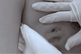 Cấp cứu lấy mô hoại tử cho cô gái áp xe nặng sau tiêm filler nâng vòng một