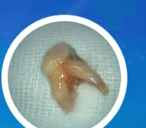 Nhổ răng tại phòng khám tư, răng rơi vào phế quản trẻ 8 tuổi