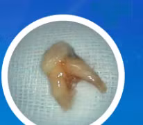 Nhổ răng tại phòng khám tư, răng rơi vào phế quản trẻ 8 tuổi