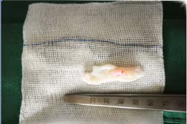 Lối sống sai hại người trẻ tuổi thoát vị đĩa đệm nguy cơ liệt