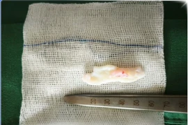 Lối sống sai hại người trẻ tuổi thoát vị đĩa đệm nguy cơ liệt