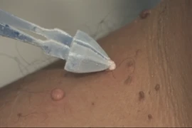 Cách chăm sóc da sau điều trị liệu pháp lạnh