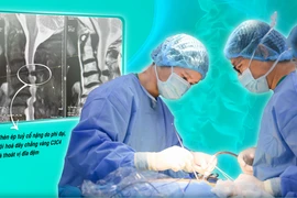 Hẹp ống sống dễ liệt vận động cần giải ép sớm