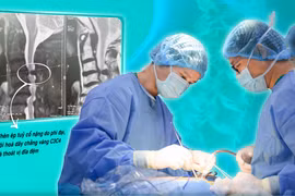 Hẹp ống sống dễ liệt vận động cần giải ép sớm