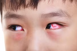 Bộ Y tế cảnh báo đau mắt đỏ gia tăng, nguy cơ lây nhiễm tại bể bơi