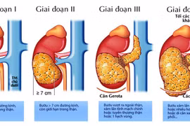 Ung thư thận gia tăng đáng báo động ở người trẻ