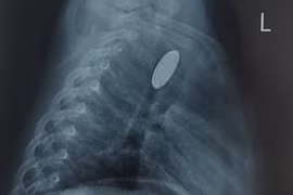 Nghỉ hè, 8 trẻ nuốt dị vật đường tiêu hóa