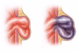 Thoát vị bẹn nghẹt, cẩn trọng tránh biến chứng nguy hiểm
