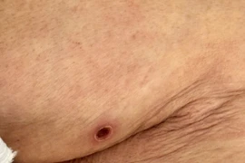 Bệnh nhân 81 tuổi viêm phổi, tổn thương gan vì sốt mò