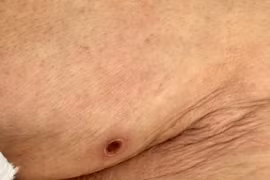 Bệnh nhân 81 tuổi viêm phổi, tổn thương gan vì sốt mò