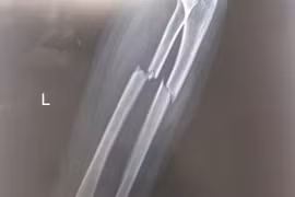 Bé trai 7 tuổi gãy xương cẳng tay, suýt mất vận động sau cú ngã xe đạp