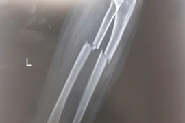Bé trai 7 tuổi gãy xương cẳng tay, suýt mất vận động sau cú ngã xe đạp