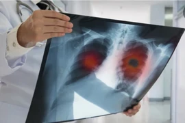 10-25% người bị ung thư phổi chưa từng hút thuốc