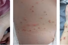 Sẩn ngứa da do nhiễm bọ chét từ chó, mèo