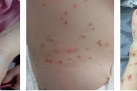 Sẩn ngứa da do nhiễm bọ chét từ chó, mèo