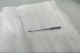 Bé 11 tuổi nuốt kim may, suýt mất mạng vì tai nạn bất ngờ