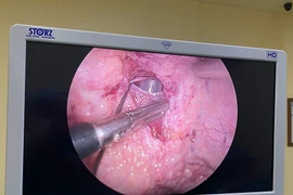 Nhịn tiểu dễ vỡ bàng quang tự phát biến chứng nguy hiểm